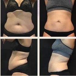 Ariya Aesthetics - Coolsculpting at Ariya Aesthetics
