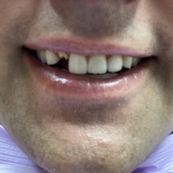 Draper Smiles - Before - General Dentistry Near Me - Draper, Utah