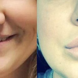 Omni Medspa by Revita - Juvaderm Ultra Plus Lip Filler. Before & After.