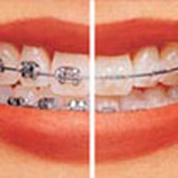 Mantel Orthodontics - We offer clear and metal braces.