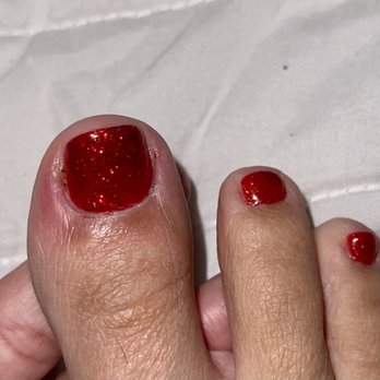 Citrus Nail Bar Lucas - Infected day 1 - Nail Salons Near Me - Lucas, Texas Citrus Nail Bar Lucas - Infected day 1 - Nail Salons Near Me - Lucas, Texas