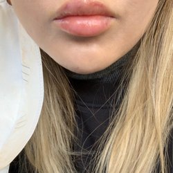 Efface Aesthetics - About 3 days after injection with some bruising