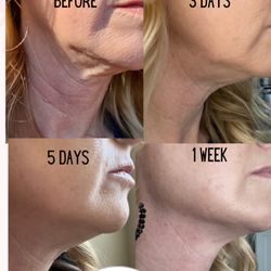 Love Yourself Body Contouring - Our skin tightening product is one of our outstanding products