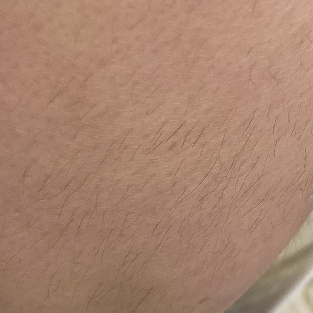 SEV Laser - No difference - Laser Hair Removal Near Me - Rancho Cucamonga, California SEV Laser - No difference - Laser Hair Removal Near Me - Rancho Cucamonga, California