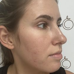 OC Esthetique and Spa - AFTER coming to Hanan. This is after 2 chemical peels and 1 micro-needling. Hanans results are incredible, she isn't even done.