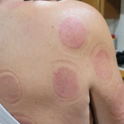 Ming Chen Acupuncture Clinic - Cupping
