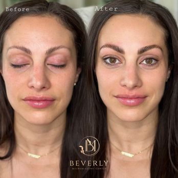 Beverly Microblading Center - Eyebrow Lamination & Henna
before|After
done by Master Artist Mahsa Bahaelou - Permanent Makeup Near Me - Los Angeles, California Beverly Microblading Center - Eyebrow Lamination & Henna
before|After
done by Master Artist Mahsa Bahaelou - Permanent Makeup Near Me - Los Angeles, California