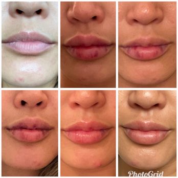 The Image Center - Top left is before, then days 1-5. I absolutely love them!!! - Plastic Surgeons Near Me - Irvine, California The Image Center - Top left is before, then days 1-5. I absolutely love them!!! - Plastic Surgeons Near Me - Irvine, California