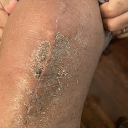 BSW Texas Spine & Joint Hospital - Scabbing