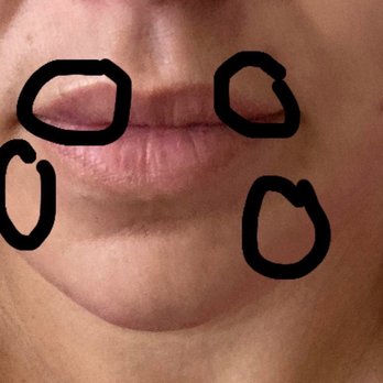 NU Med Spa - 4 units Botox, tiny filler. - Medical Spas Near Me - Los Angeles, California NU Med Spa - 4 units Botox, tiny filler. - Medical Spas Near Me - Los Angeles, California