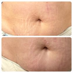 There She Glows - Body sculpting helps fade stretch marks! Book your consultation today to find out how we can help you!