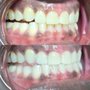 Gems Teeth Whitening
