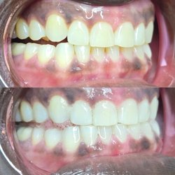 Gems Teeth Whitening - She got my teeth 5 shades whiter!!!