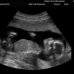 Baby's First Ultrasound - Crystal clear picture!!