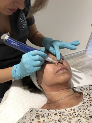 Micro-needling - SKIN PEN - SkinPen is the first FDA-approved microneedling treatment and is:

✓ Clinically tested and proven.

✓ Backed by an unparalleled commitment to safety and efficacy.

✓ Performed by leading dermatologists and estheticians.

✓ Convenient, requiring little to no downtime. 

✓ Simple, with results in just one to three 30-minute sessions.

✓ Designed to work without chemicals, heat, or stress.

✓ Engineered and made in the USA.