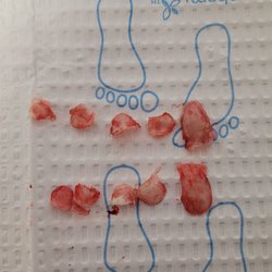 Jeremy Cook, DPM - My 10 removed toenails