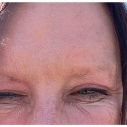 Before treatment crows feet Before treatment crows feet
