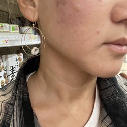Skinlabhi - Immediately after the treatment