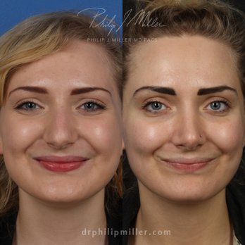 Gotham Plastic Surgery - Rhinoplasty - Cosmetic Surgeons Near Me - New York, New York Gotham Plastic Surgery - Rhinoplasty - Cosmetic Surgeons Near Me - New York, New York