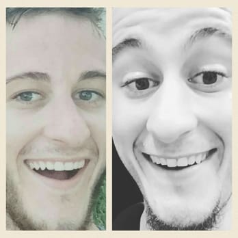 Stephen J Parr, DDS - Left side is before visiting his office and right side is after. Notice the turned in front tooth making my smile not even. - Oral Surgeons Near Me - Miami, Florida