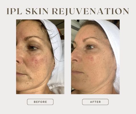 Before/After- Facial & Body Treatments - Before/After IPL, PRP, Radiofrequency, Laser, Botox, Laser Hair Removal Before/After- Facial & Body Treatments - Before/After IPL, PRP, Radiofrequency, Laser, Botox, Laser Hair Removal
