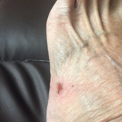 Family Nail - Pedicure injury