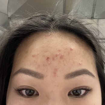Metropolis Dermatology - Before - Dermatologists Near Me - Pasadena, California Metropolis Dermatology - Before - Dermatologists Near Me - Pasadena, California