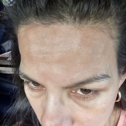 Botox forehead 1st day application Botox forehead 1st day application