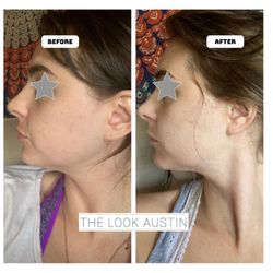 Beauty Intelligence - HIFU ultra for double chin. It's skin tightening.