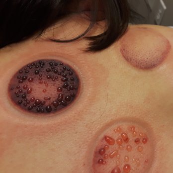 Angel's Healing - 2nd degree burn fromfrom cupping - Acupuncture Near Me - Las Vegas, Nevada Angel's Healing - 2nd degree burn fromfrom cupping - Acupuncture Near Me - Las Vegas, Nevada