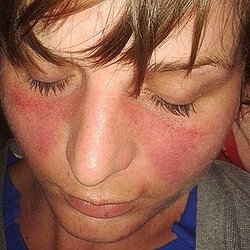 Millcreek Rheumatology - Young woman with malar rash, typically found in systemic lupus erythematosus (SLE)