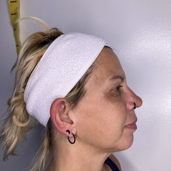 CLR You - This is one of my "after" photos. Look at that jawline!! - Health Coach Near Me - Los Angeles, California