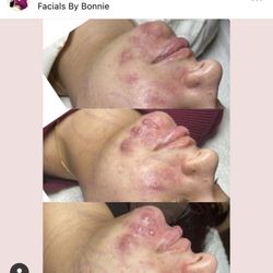Facials by Bonnie - Bonnie's magic -- bottom was before the first treatment and the top is after 5 treatments