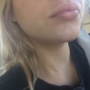 Barrett Plastic Surgery - 3 days after - Cosmetic Surgeons Near Me - Beverly Hills, California Barrett Plastic Surgery - 3 days after - Cosmetic Surgeons Near Me - Beverly Hills, California