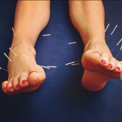 Charleston Acupuncture
