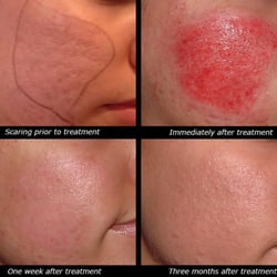MyFace - Collagen Induction Therapy (Skin Needling) for acne scarring, wrinkles, large pores, smooth skin.