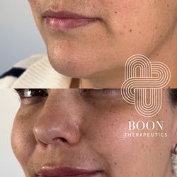 Boon Therapeutics - Natural, subtle lip refresh with filler.