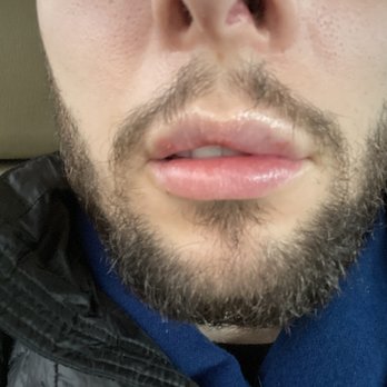 Pure Med Spa - Poor lip injection - Medical Spas Near Me - Chicago, Illinois
