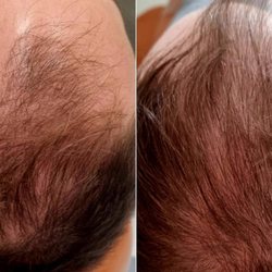 Fotona HairRestart is an advanced laser therapy that stimulates the scalp to promote hair follicle regeneration and hair growth.