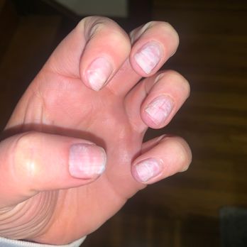 Glamour Nails - My nails after having the acrylics removed - Nail Salons Near Me - Crestview Hills, Kentucky Glamour Nails - My nails after having the acrylics removed - Nail Salons Near Me - Crestview Hills, Kentucky
