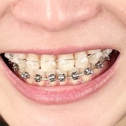 Pair Orthodontics - Damon braces with clear on the top