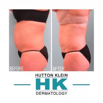 KleinLipo - #BodyByKlein 
Incredible Tumescent Liposuction results of the Abdomen. Look and feel your best this summer!
  #liposuction #Dermatologist - Cosmetic Surgeons Near Me - San Juan Capistrano, California