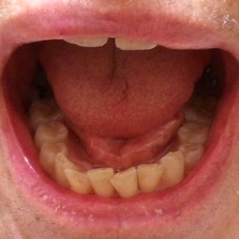 Mountain View Dental  - Lower teeth after a so called cleaning at Mountain View Dental - General Dentistry Near Me - Ellensburg, Washington