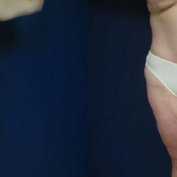 Westfield Plastic Surgery Center - Body Lift - Cosmetic Surgeons Near Me - Omaha, Nebraska