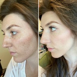 Left: day of the BBL & the right: 5 days later. I have no face make up (foundation, concealer or powder) on in either photo.