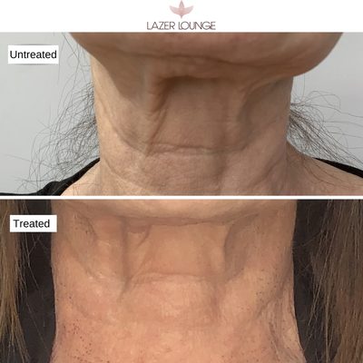 Plasma pen skin tightening - Plasma pen is a skin tightening method that can work anywhere on your body. Visit website lazerlounge.com or IG/FB @lazerlounge to learn more Plasma pen skin tightening - Plasma pen is a skin tightening method that can work anywhere on your body. Visit website lazerlounge.com or IG/FB @lazerlounge to learn more