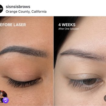 SIS & SIS - Laser tattoo removal 1st session. Result vary per person - Permanent Makeup Near Me - Garden Grove, California SIS & SIS - Laser tattoo removal 1st session. Result vary per person - Permanent Makeup Near Me - Garden Grove, California