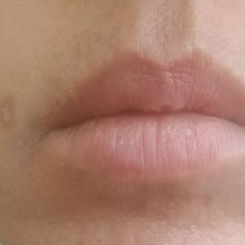 LaserAway - Laser Hair Removal Near Me - Novato, California