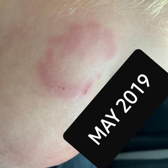 Imagination Station Early Learning Center - Bite mark on face, broke skin. - Child Care & Day Care Near Me - Henderson, Nevada Imagination Station Early Learning Center - Bite mark on face, broke skin. - Child Care & Day Care Near Me - Henderson, Nevada