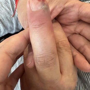 College Vista Post Acute - Another wound that they did not treat. He just kept getting hurt and hurt with no treatment. - Skilled Nursing Near Me - Los Angeles, California